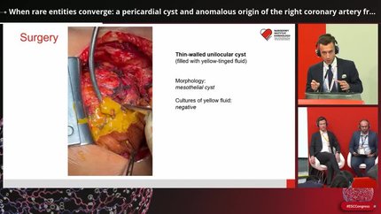 When rare entities converge: a pericardial cyst and anomalous origin of the right coronary artery from pulmonary trunk case report