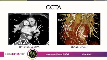 Left bundle branch block and left ventricular systolic dysfunction as an expression of complex coronary anomaly in a young woman: a multimodality imaging approach