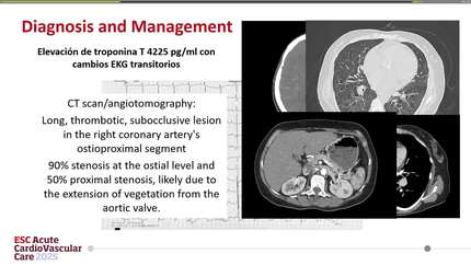 Large aortic valve vegetation protruding into the right coronary artery: stemi as result?
