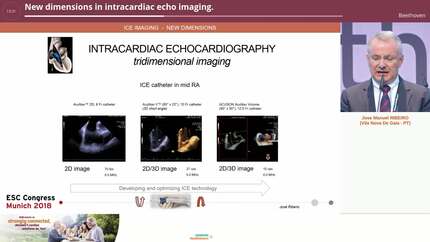 New dimensions in intracardiac echo imaging.