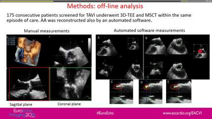 A comparison among conventional 3D-transesophageal echocardiography manual analysis, 3D automatic software analysis and computed tomography for the aortic annulus sizing in TAVI patients
