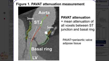 CT imaging of periaortic valve adipose tissue: clinical implication to evaluate severity of aortic stenosis