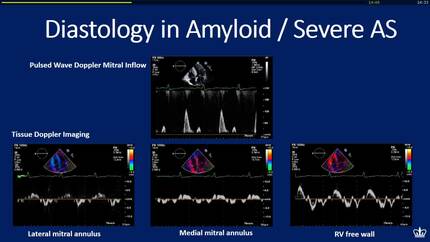 ASE: Young Investigator Awardee presentation: “Echocardiographic predictors of transthyretin cardiac amyloidosis among patients with severe aortic stenosis 
Undergoing transcatheter aortic valve replacement”.