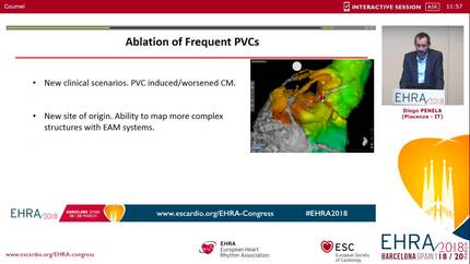 Complications during ablation of ventricular arrhythmias