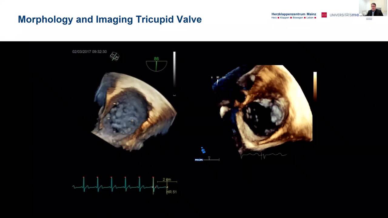 Transforming structural heart intervention with new visualization tools.