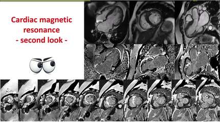 Not every extensive late gadolinium enhancement is cardiac amyloidosis – an FHOD3 cardiomyopathy undercover