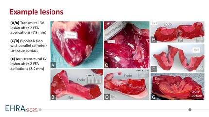 First experience using a novel 3D enabled large-area focal pulsed field ablation catheter for ventricular ablation