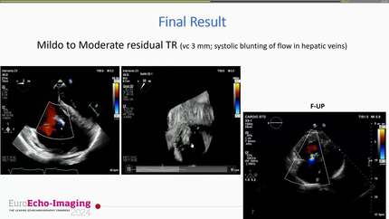 Challenge 4: primary tricuspid regurgitation