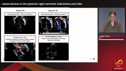 Assist devices in the systemic right ventricle: indications and risks