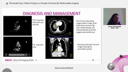 Pericardial Cyst: A Rare Finding in a Female Confirmed By Multimodality Imaging.