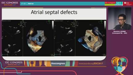 3D echocardiography