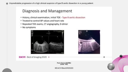 Unpredictable progression of a high clinical suspicion of type B aortic dissection in a young patient.