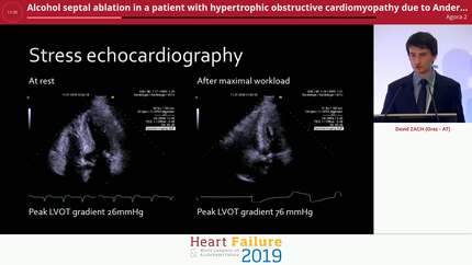 Alcohol septal ablation in a patient with hypertrophic obstructive cardiomyopathy due to Anderson-Fabry disease