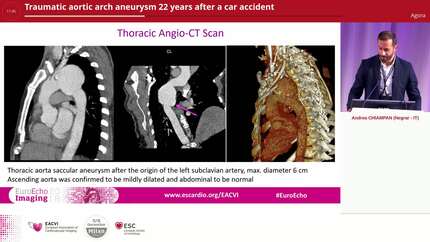 Traumatic aortic arch aneurysm 22 years after a car accident