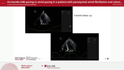His bundle (HB) pacing or atrial pacing in a patient with paroxysmal atrial fibrillation and valvular cardiomyopathy.