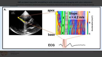 SWE can detect myocardial remodelling in aortic stenosis patients undergoing aortic valve replacement