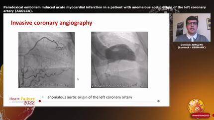 Paradoxical embolism induced acute myocardial infarction in a patient with anomalous aortic origin of the left coronary artery (AAOLCA).