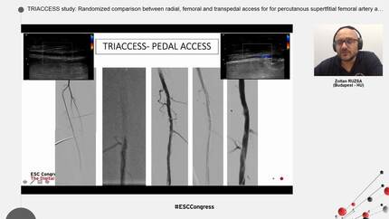 TRIACCESS study: Randomized comparison between radial, femoral and transpedal access for for percutanous supertfitial femoral artery angioplasty
