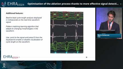 Optimisation of the ablation process thanks to more effective signal detection using an innovative ep recording system and mapping integration