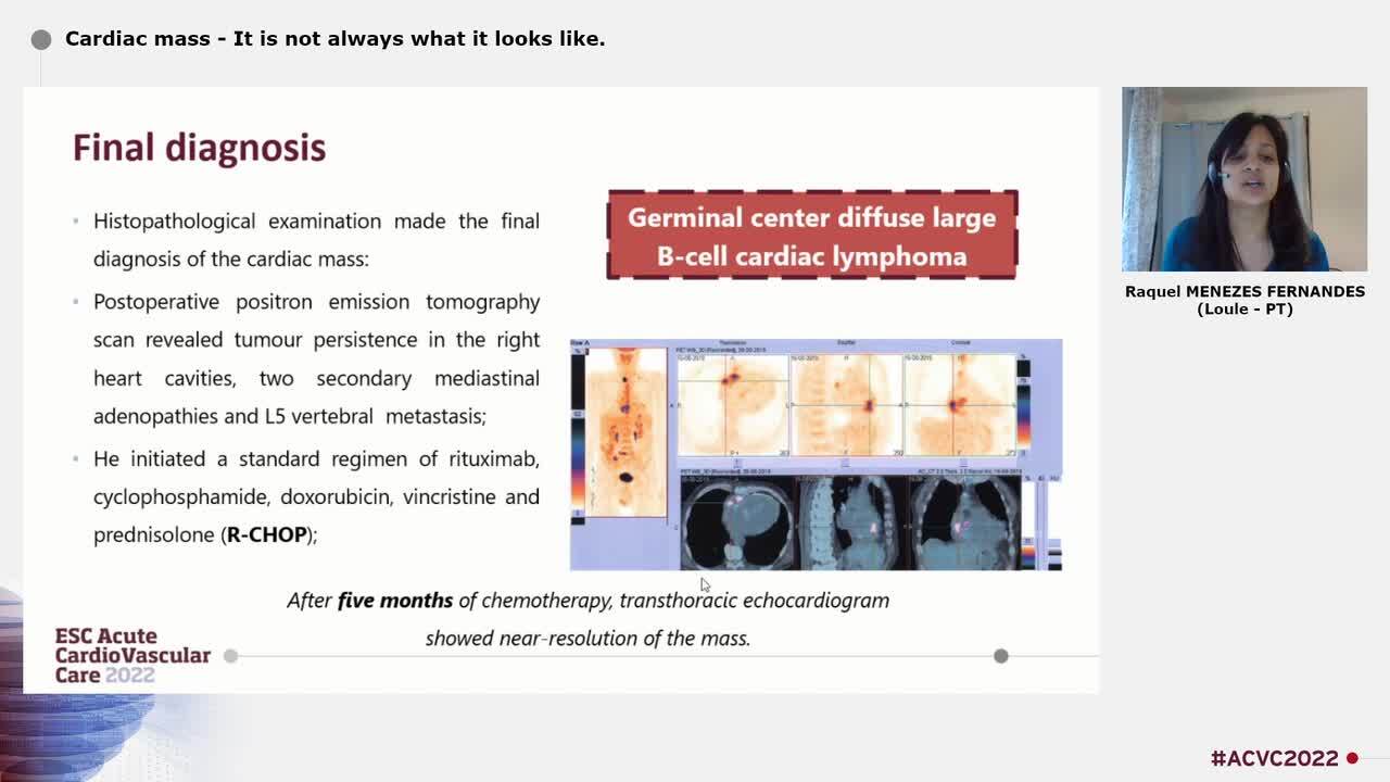 Cardiac mass - It is not always what it looks like.