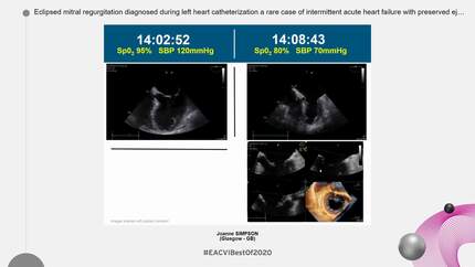 Eclipsed mitral regurgitation diagnosed during left heart catheterization  a rare case of intermittent acute heart failure with preserved ejection fraction.