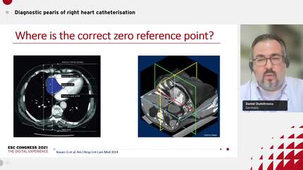 How to perform right heart catheterisation: doing things right.