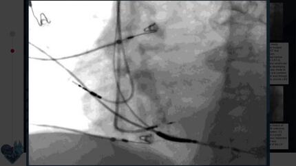 The use of left bundle branch pacing as a bail-out in case of CRT pacing failure: a case series