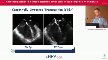 Challenging cardiac implantable electronic device cases in adult congenital heart disease