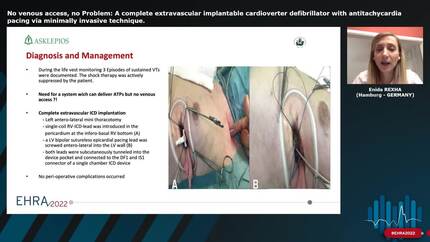No venous access, no Problem: A complete extravascular implantable cardioverter defibrillator with antitachycardia pacing via minimally invasive technique.