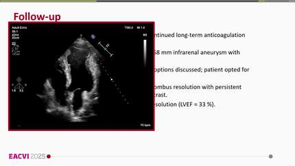 Persistent apical thrombus overlying an ischemic aneurysm: a multimodality imaging insight