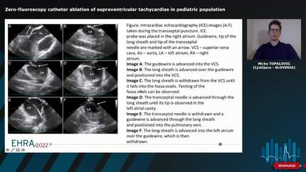 Zero-fluoroscopy catheter ablation of supraventricular tachycardias in pediatric population