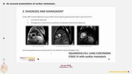 An unusual presentation of cardiac metastasis.