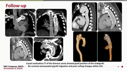 Hybrid thoracic endovascular repair of a large, saccular aortic arch aneurysm and coil embolization of left subclavian artery in a 31 y/o female with takayasu arteritis and multiple cerebral aneurysms