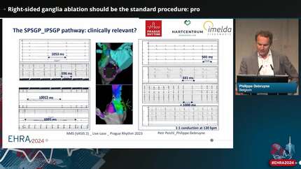 Right-sided ganglia ablation should be the standard procedure: pro