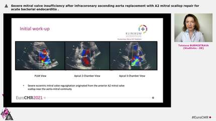 Severe mitral valve insufficiency after infracoronary ascending aorta replacement with A2 mitral scallop repair for acute bacterial endocarditis
.