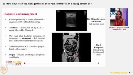 How simple can the management of deep vein thrombosis in a young patient be?
