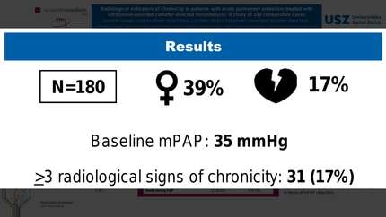 Radiological indicators of chronicity in patients with acute symptomatic pulmonary embolism treated with ultrasound-assisted catheter-directed thrombolysis: a study of 180 consecutive cases