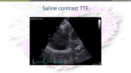 A case of right atrial diverticulum initially diagnosed in 58 years old female patient.