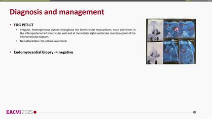 When the body Is silent but the heart speaks: Isolated cardiac sarcoidosis diagnosed through advanced imaging