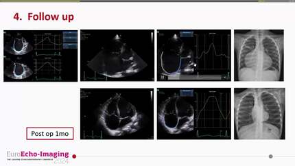 Fetal diagnosed right atrial aneurysm