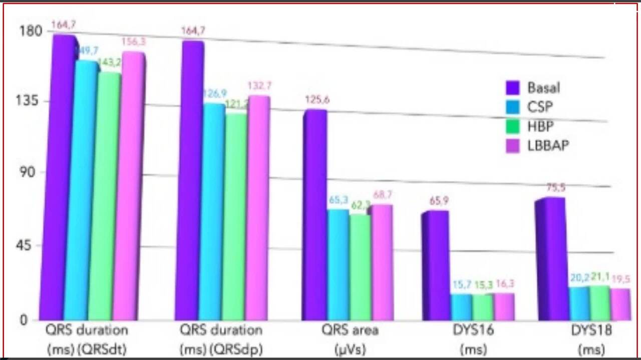 Cardiac resynchronization therapy guided by UHF-ECG: comparison between his bundle pacing and left bundle branch area pacing