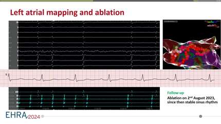 Successful ablation of left atrial macroreentrant tachycardia through an implanted interatrial shunt device