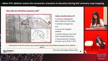 When PVC ablation meets the coronaries: transient st elevation during left coronary cusp mapping