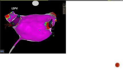Atrial fibrillation and flutter ablation with 3D mapping in a patient with Kartagener's Syndrome via mirror image septostomy on fluoroscopy
