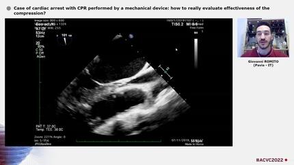 Case of cardiac arrest with CPR performed by a mechanical device: how to really evaluate effectiveness of the compression?