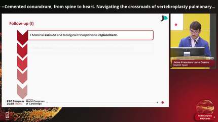Cemented conundrum, from spine to heart. Navigating the crossroads of vertebroplasty pulmonary embolism and myocardial infarction