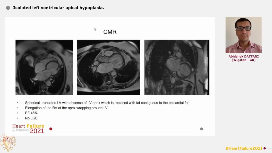 Isolated Left Ventricular Apical Hypoplasia