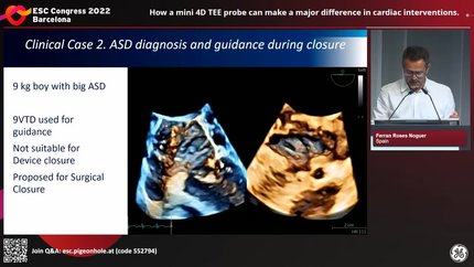 How a mini 4D TEE probe can make a major difference in cardiac interventions.
