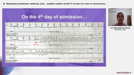 Moyamoya syndrome, seizures, and... sudden cardiac arrest ?! A case of a rare co-occurrence.