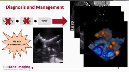 Transcatheter tricuspid valve-in ring implantation: a reasonable solution after surgical failure.